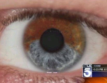 瞳の色を変えるレーザー治療の現在地